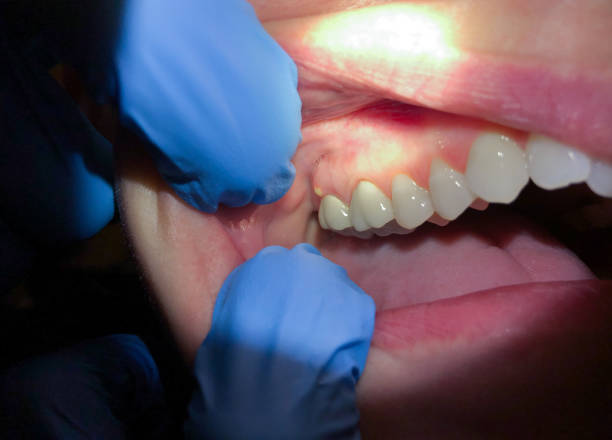 Best Knocked-Out Tooth (Avulsed Tooth) Treatment in North Haledon, NJ